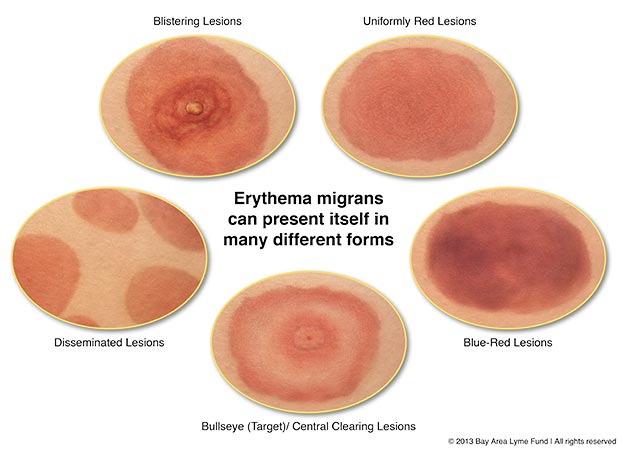 a) Day 1, patient presents with flat erythematous rash with scattered