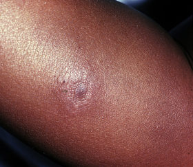 Inadequacy in the medical field to accurately diagnose a Lyme rash
