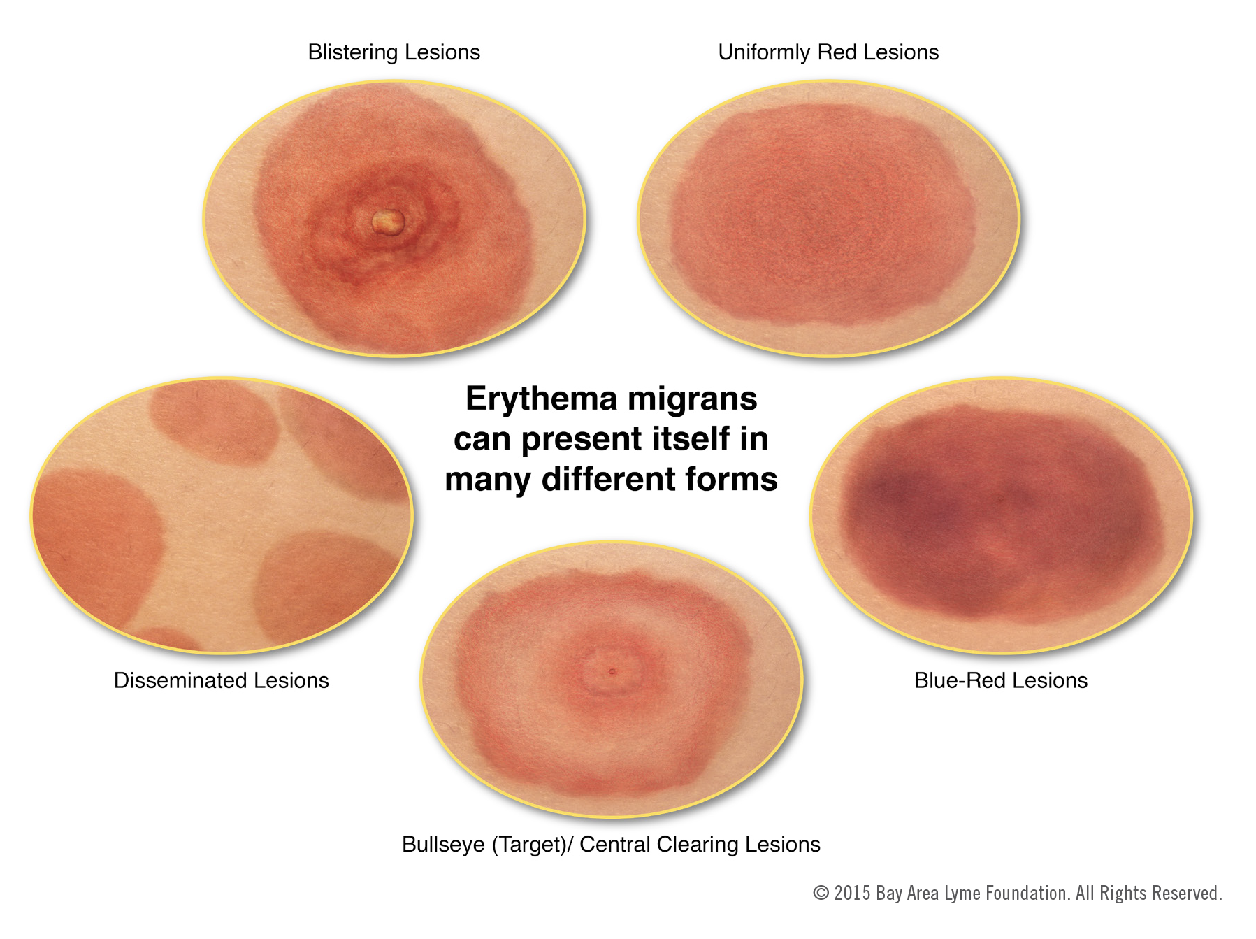 Lyme Rashes