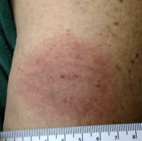 Lyme rash: lesion with a uniform pattern