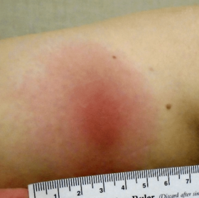 Lyme rash: lesion with a darkened center. Not a bullseye rash.
