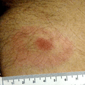 "Bullseye" Lyme rash: lesion with the classic, ring-within-a-ring pattern